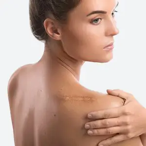 Laserowe usuwanie blizn Lodz Pro Laser Clinic