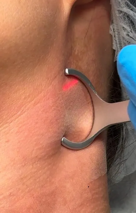 blizny, klinika, kosmetologia estetyczna, laser, laser frakcyjny, laser frakcyjny co2, laseroterapia