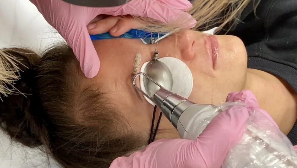 makijaż permanentny, usuwanie makijażu permanentnego, techniki usuwania makijażu permanentnego, mikropigmentacja, laserowe usuwanie makijażu, medycyna estetyczna