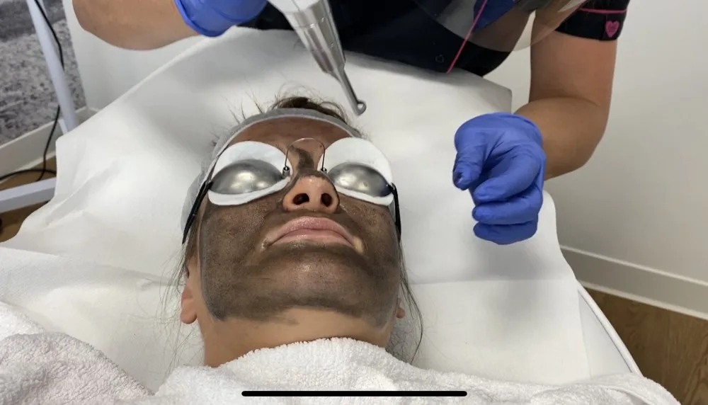 redukcja zmarszczek, zabiegi na zmarszczki, botoks, kwas hialuronowy, lifting twarzy, laserowe usuwanie zmarszczek, medycyna estetyczna