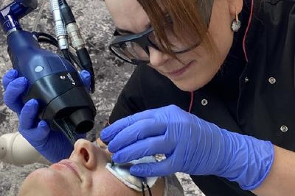 usuwanie przebarwień, likwidacja przebarwień, laser frakcyjny CO2, medycyna estetyczna, usuwanie przebarwień na twarzy