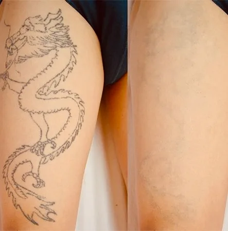 na czy polega zabieg laserowego usuwania tatuazu laserowe usuwanie tatuażu Łódź, usuwanie tatuażu laserem Q-Switch, jak usunąć tatuaż, skuteczne usuwanie tatuażu, bezpieczne usuwanie tatuaży