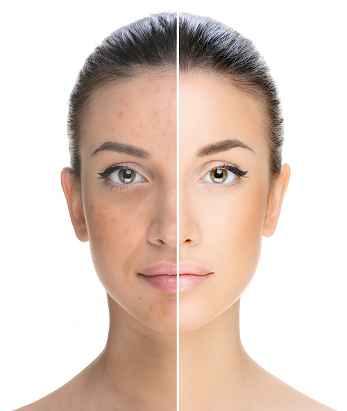 peelingi chemiczne latem, kwasy medyczne latem, peeling dla skóry trądzikowej, peeling przeciwstarzeniowy, peelingi całoroczne, peelingi chemiczne latem, peelingi chemiczne Łódź, peelingi medyczne, pHformula efekty, pHformula Łódź, pHformula peelingi, resurfacing skóry, zabiegi na twarz latem