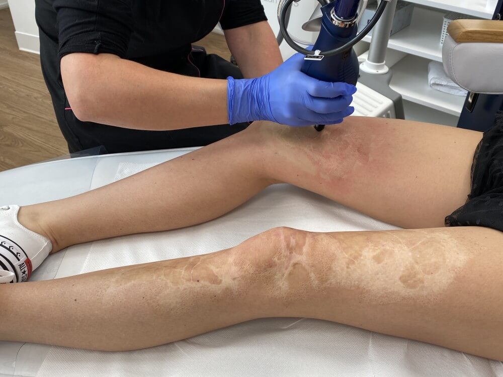 laser frakcyjny eCO2, laserowe usuwanie blizn, usuwanie blizn laserem Lodz Pro Laser Clinic