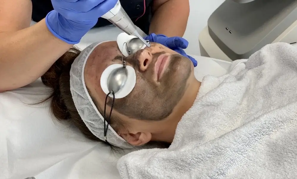 laserowy peeling węglowy Black Doll