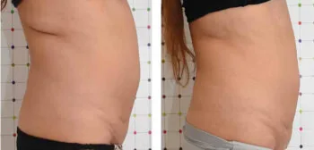 modelowanie sylwetki onda boki