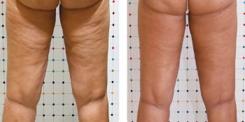 modelowanie sylwetki onda bryczesy