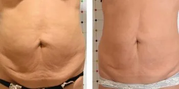 Modelowanie sylwetki ONDA - Brzuch