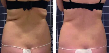 modelowanie sylwetki onda plecy motylki