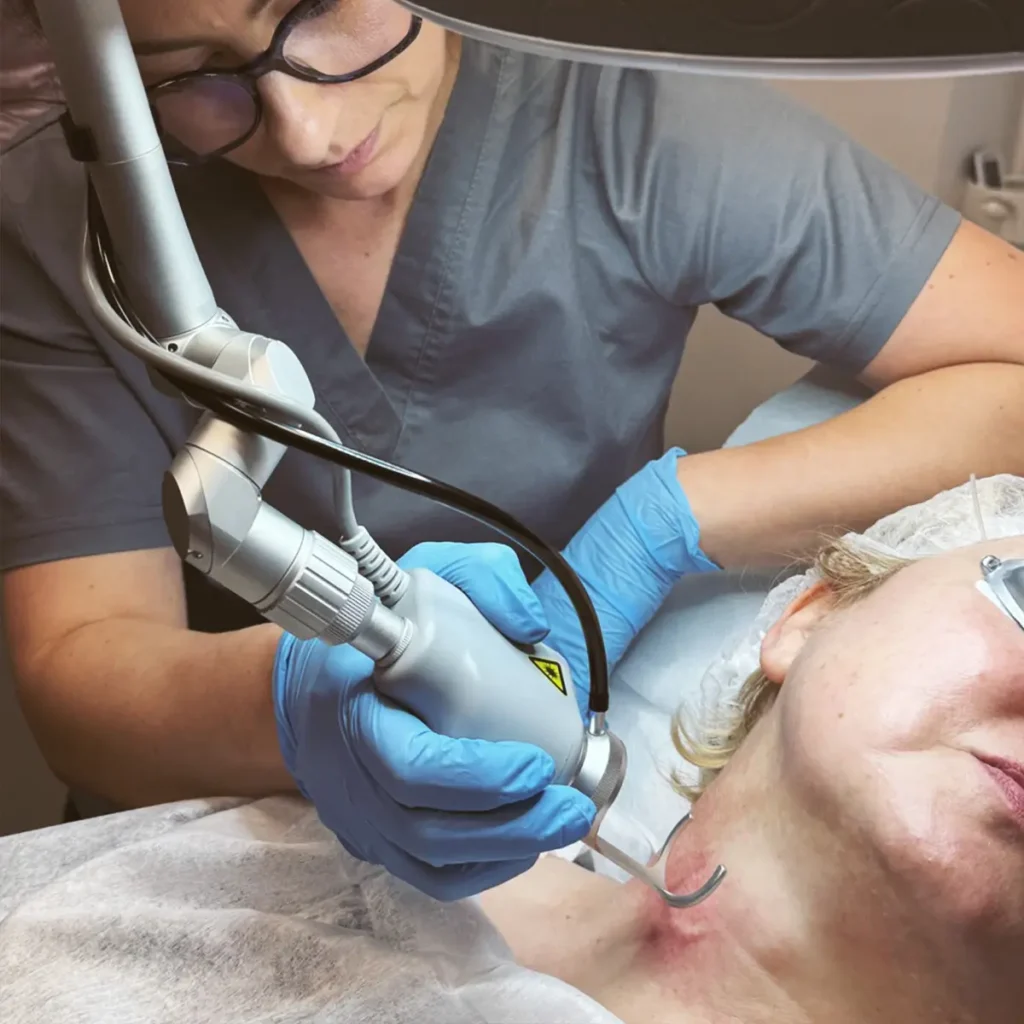Laser frakcyjny Pro laser clinic, usuwanie blizn, usuwanie przebarwień, resurfacing twarzy
