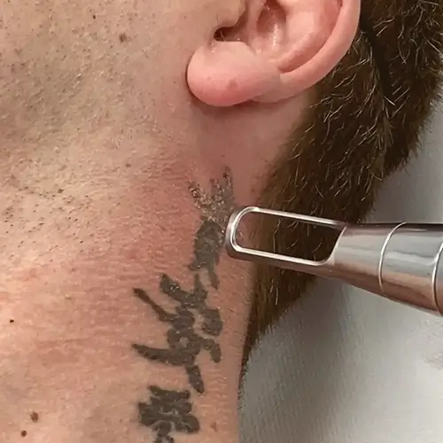 Laseroterapia Lodz Pro Laser Clinic, laserowe usuwanie tatuażu
